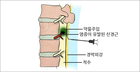염증이 유발된 신경근에 약물주입
